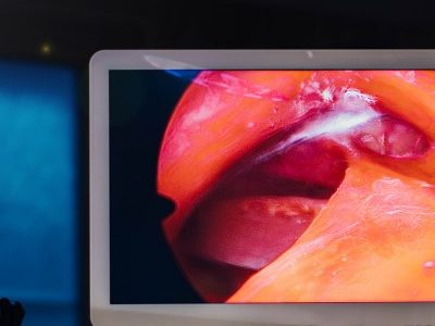 Endoscopic spine surgery